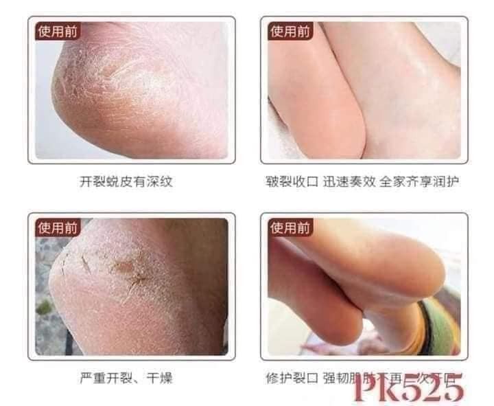 KEM CAO NGỰA TRỊ NỨT NẺ CHÂN TAY - SET 3 HỦ 